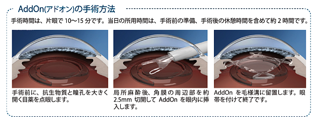 ”AddOnの手術方法” ”手術方法”