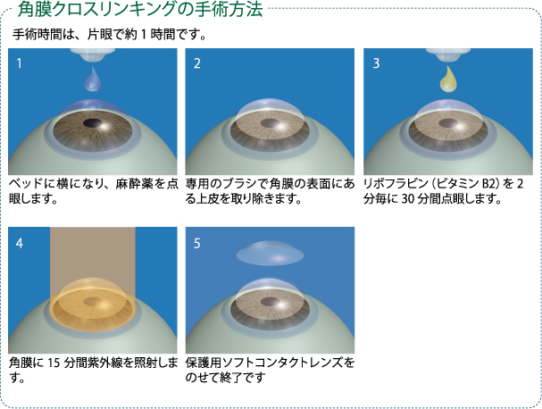 ”角膜クロスリンキングの手術方法” ”手術方法”