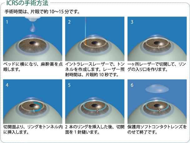 ”ICRSの手術方法” ”手術方法”
