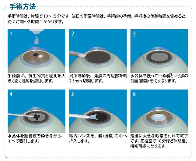 ”多焦点眼内レンズの手術方法” ”手術方法”