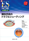 円錐角膜に対する新しい治療：角膜リング
