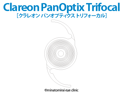 PanOptix Trifocal