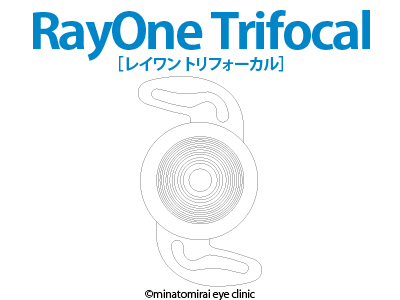 RayOne Trifocal