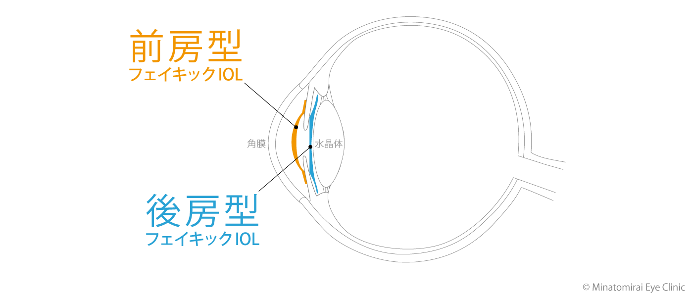 ICL